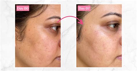 Reduced hyperpigmentation: