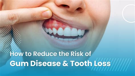 Reduced risk of dental disease