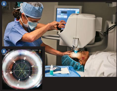 Refractive Surgery: