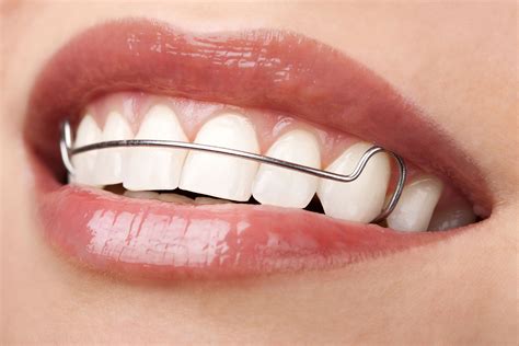 Removable retainers