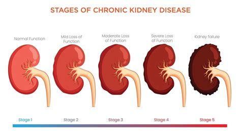 Renal Kidney Failure Stages: A Guide to CKD Progression