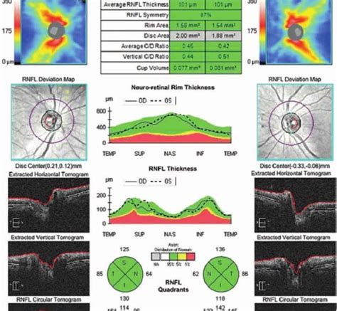 Retina and Optic Nerve Imaging PDF