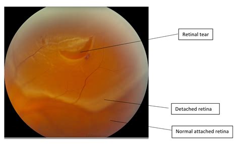 Retinal Detachment Diagnosis and Management Kindle Editon