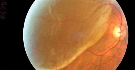 Retinal Detachment Diagnosis and Management Kindle Editon