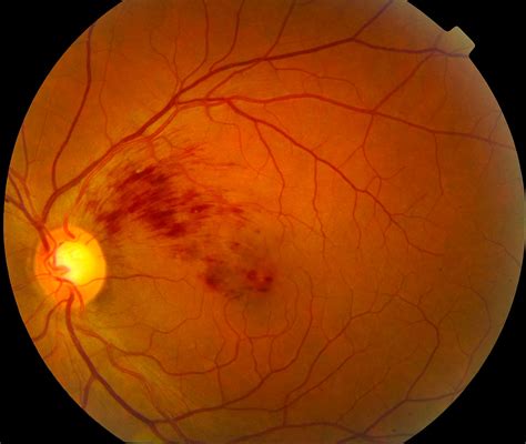 Retinal Vascular Disorders Doc