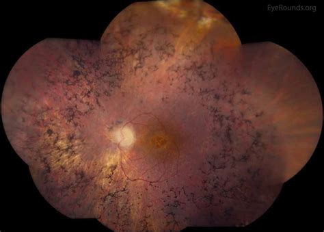 Retinitis pigmentosa (RP)