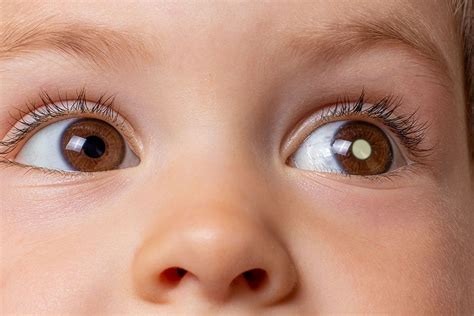 Retinoblastoma: