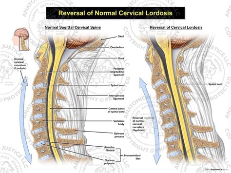 Reversal of the Cervical Lordosis: A Comprehensive Guide