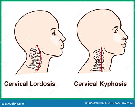 Reversal of the Cervical Lordosis: Your Guide to Understanding and Treating Neck Hump