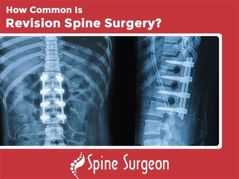 Revision Spine Surgery Epub