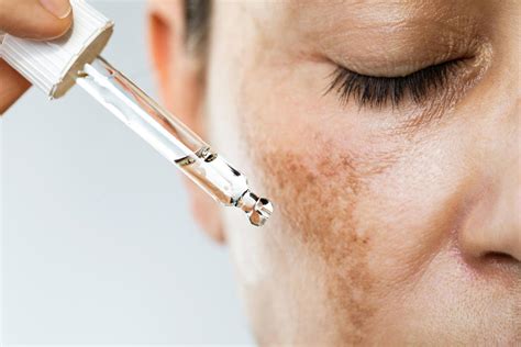 Revolucione sua Pele: Desvendando o Poder do Melasma Hidroquinona