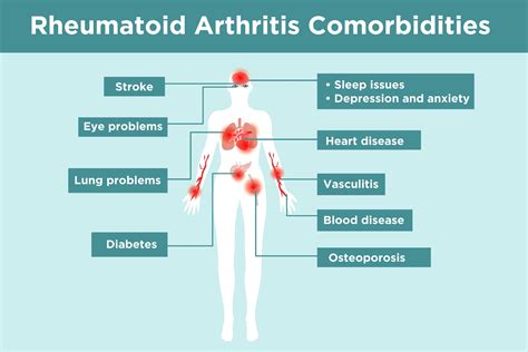 Rheumatoid arthritis (RA):