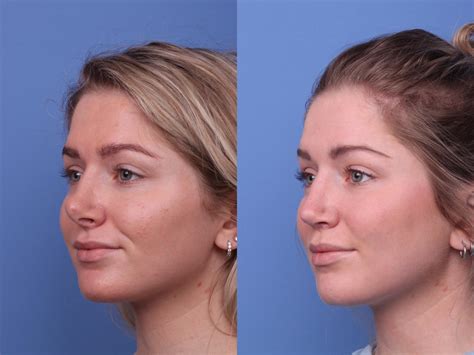 Rhinoplasty