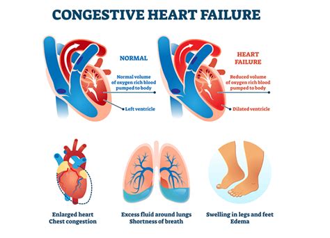 Right-Sided Congestive Heart Failure: A Closer Look