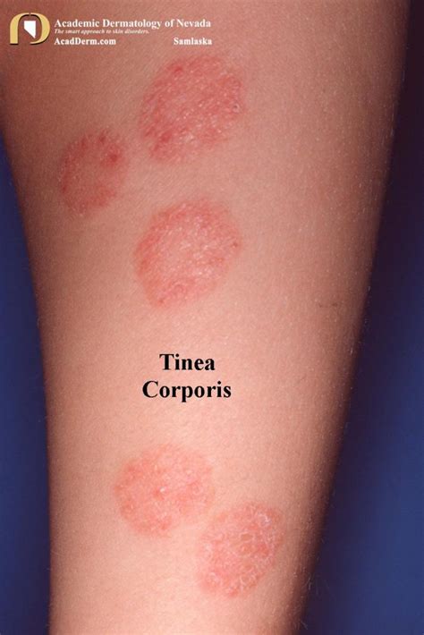 Ringworm (tinea corporis)