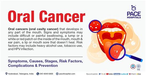 Roof of Mouth Cancer: A Comprehensive Guide to Prevention, Symptoms, and Treatment