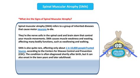 SMN-303: The 303rd Solution for Spinal Muscular Atrophy