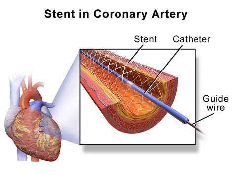 SamiraHeart: A Revolutionary Stent System for Complex Coronary Artery Disease