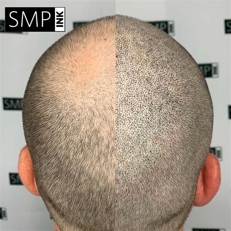 Scalp Micropigmentation: