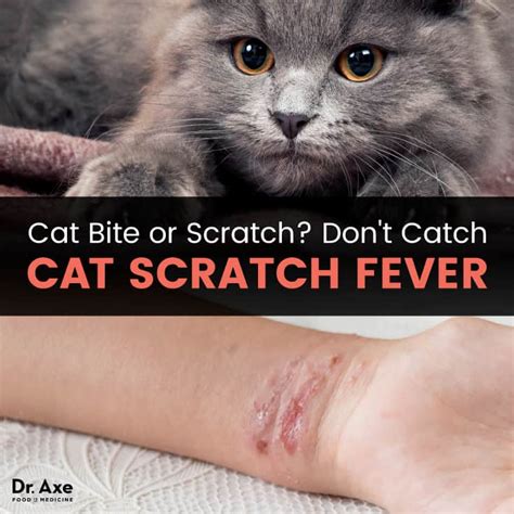 Scratch Fever Kindle Editon