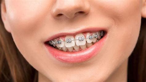 Self-Ligating Ceramic Braces: The Ultimate Guide to Enhancing Your Smile