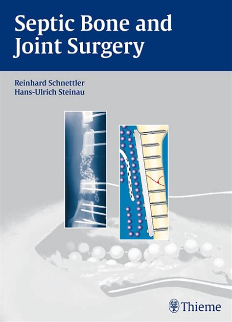 Septic Bone Surgery Epub