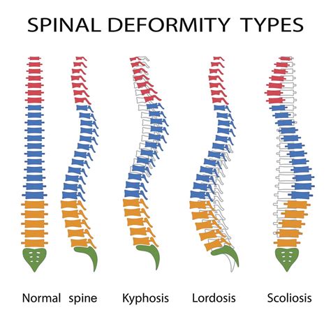 Severity of Spinal Defect: