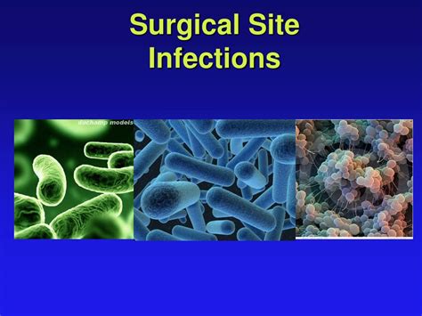 SharkBittens: Exploring the Emerging Field of Surgical Site Infections