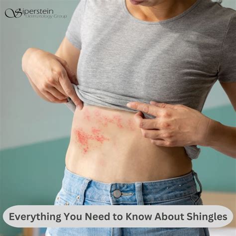 Shingles