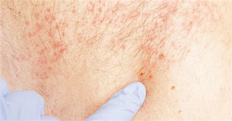 Shingles How Long Does It Last: The Definitive Guide