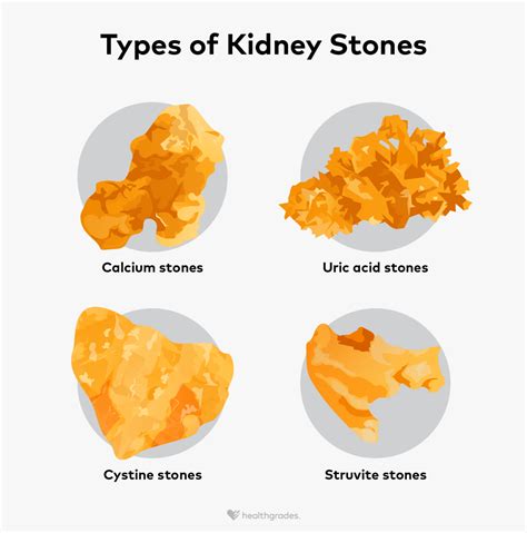 Simion's Kidney Stone