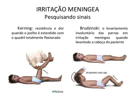 Sinal de Kernig e Brudzinski: Indicadores de Rigidez Meníngea em Meningites