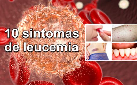 Sintomas da Leucemia: Um Guia Completo para Entender e Reconhecer