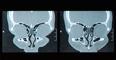 Sinusopatia Maxilar Bilateral: Um Guia Completo para Entender, Prevenir e Tratar