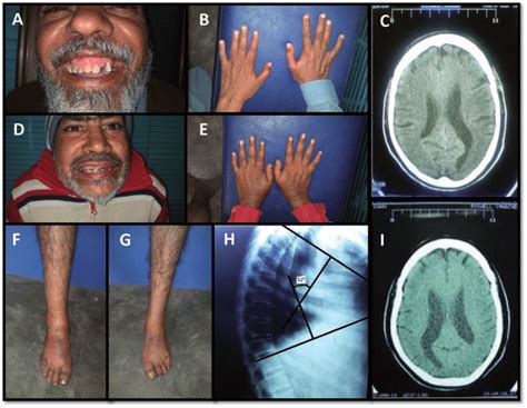 Skeletal Abnormalities: