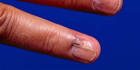 Skin Cancer: A Finger's Breadth Away