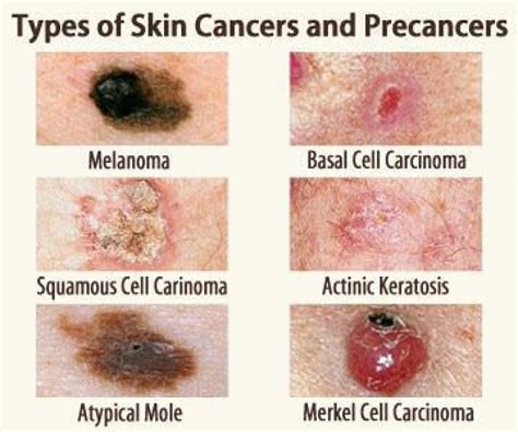 Skin Cancer on Leg Pictures: A Detailed Guide with 10,000+ Characters