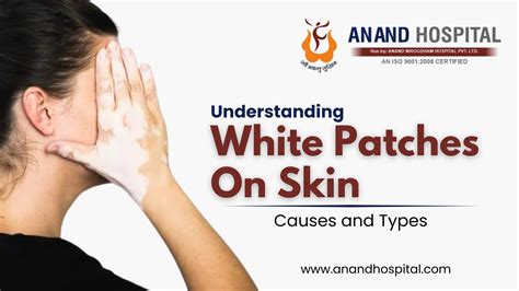 Skin Condition White Patches: A 5-Minute Guide