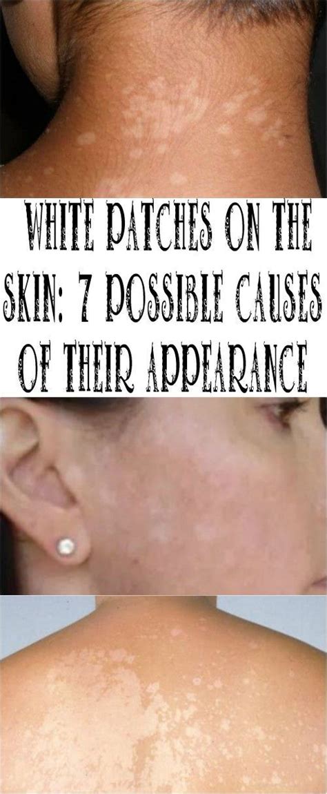 Skin Disorder with White Patches: 10,000+ Words of In-Depth Information