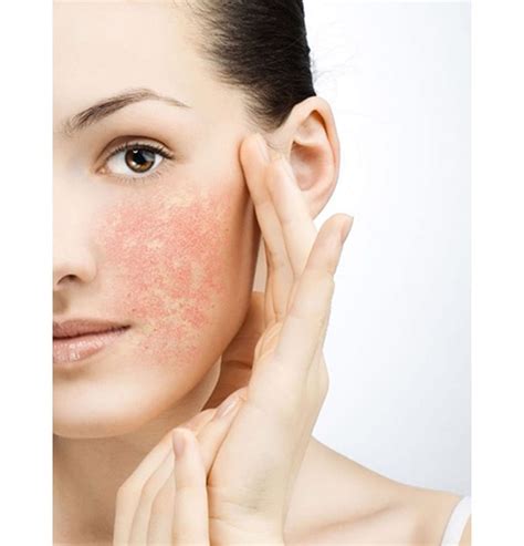 Skin Sensitivity: