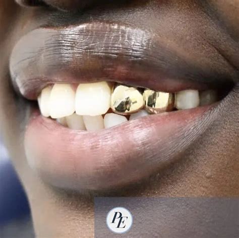 Smile Bright Without Breaking the Bank: Unveiling Teeth Cap Prices