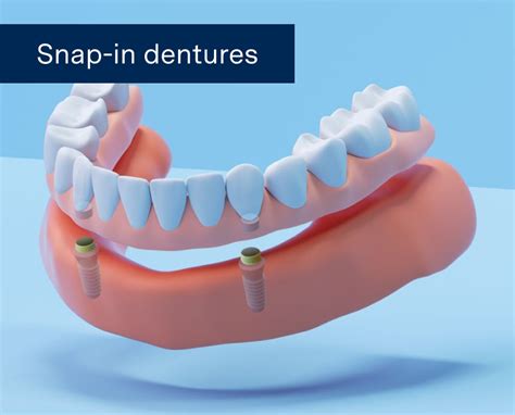 Snap-in Dentures Cost with Insurance: Unveiling the Affordable Options