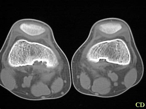 Soft Tissue Ossification Reader