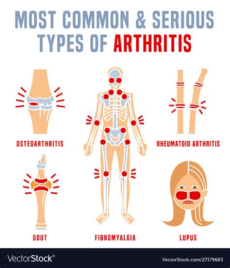 Some of the most common types of arthritis include: