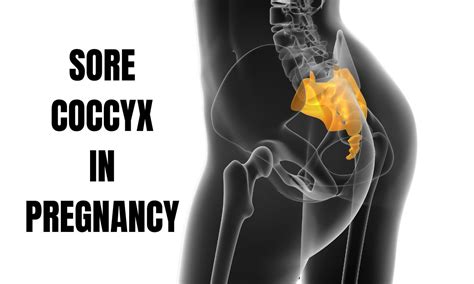 Sore Coccyx During Pregnancy: A Comprehensive Guide