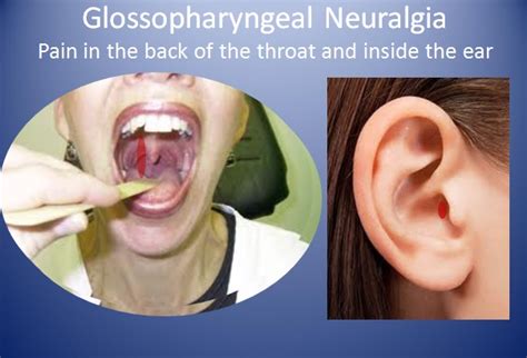 Speaking Spanish Hurts My Jaw: Unmasking the Truth Behind Glossopharyngeal Neuralgia