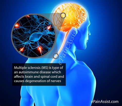 Speech and Language Disorders in Multiple Sclerosis Reader