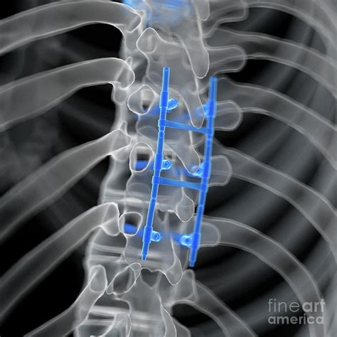 Spinal Fusion Science and Technique Epub