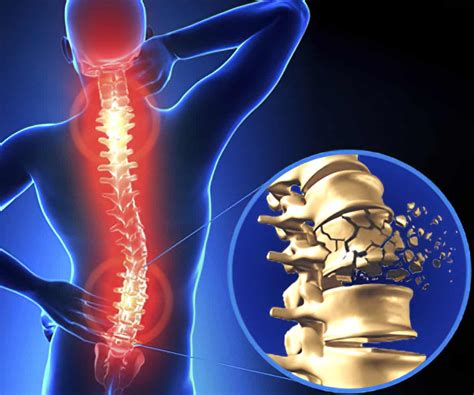 Spinal cord injuries: