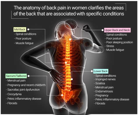 Spine Female Chart Back Pain